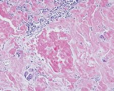 Richard-Allan Scientific Amyloid Stain